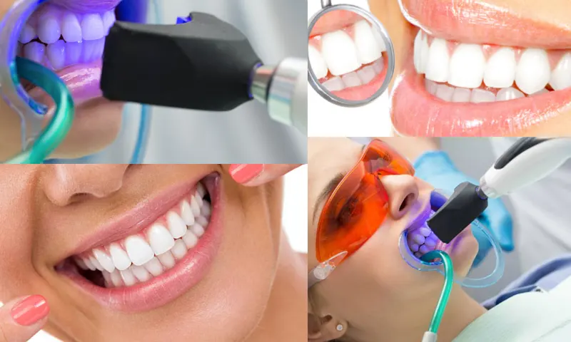 Diş Beyazlatma Nedir ve Neden Tercih Edilir?