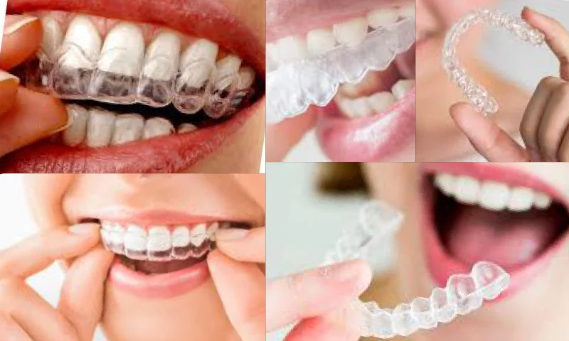Neden Zirkonyum Diş Kaplama Tercih Etmelisiniz