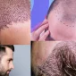 İstanbul'da Saç Ekimi - زراعة الشعر في اسطنبول Nerede Yaptırılır?