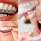 Neden Zirkonyum Diş Kaplama Tercih Etmelisiniz
