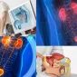 Prostatik Arter Embolizasyonu Nedir?